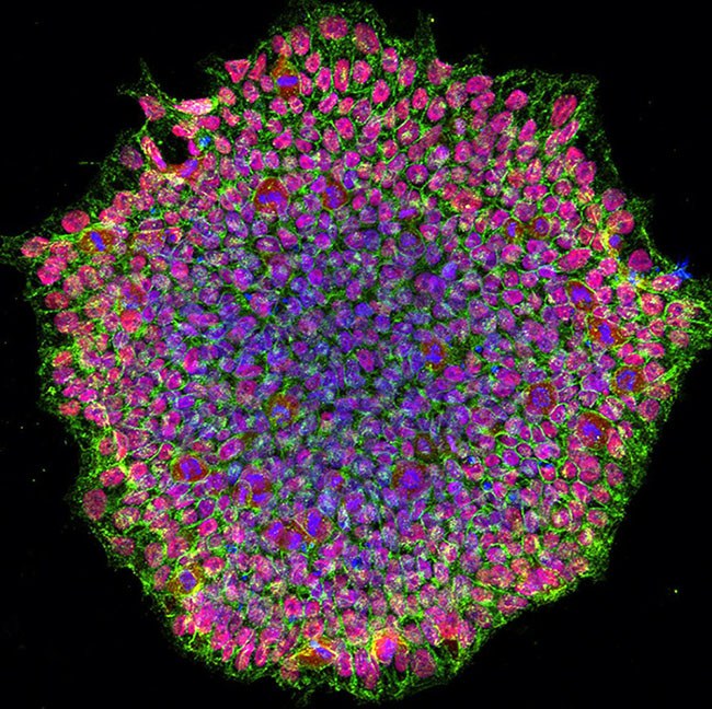 A human induced pluripotent stem cell colony from OCA1A patient.