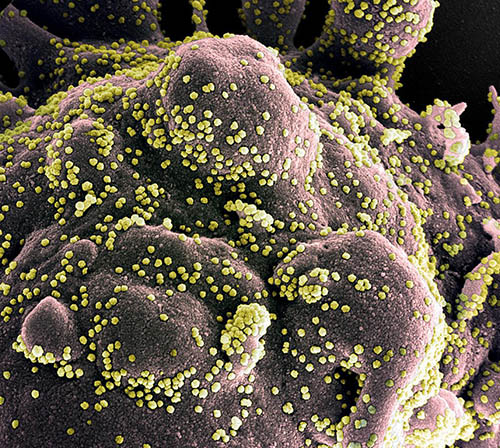 Colorized scanning electron micrograph of an apoptotic cell (gray) heavily infected with SARS-COV-2 virus particles (yellow), isolated from a patient sample