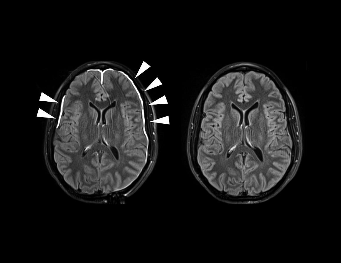 brain scans showing the meninges after damage (left) and after it has healed (right)