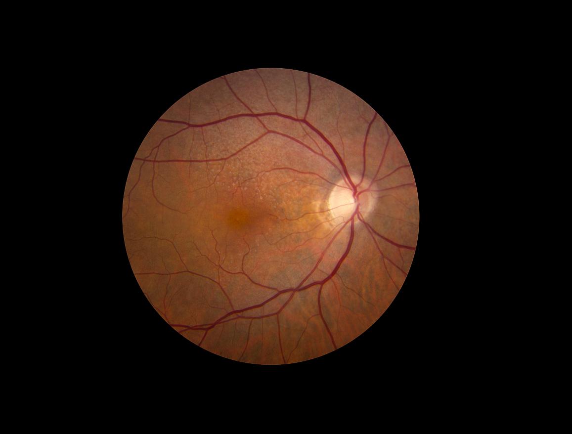 giraffe-like macular pattern in the retina of a person with a specific kind of retinal damage called a reticular pseudodrusen