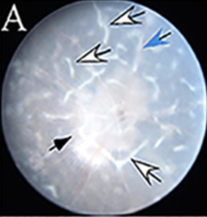 damage to the eye caused by hyperactive immune cells