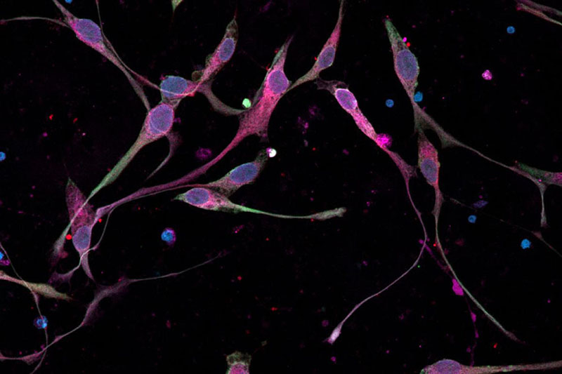 confocal micrograph shows DIPG cells, grown from patient cells, in culture