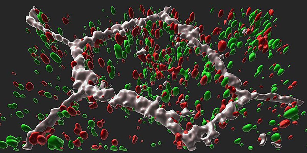 L-ORD patient RPE cell (borders are white) showing mutant protein CTRP5 (red) trapped inside the cell and partially in autophagosomes (green).