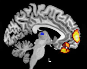 fMRI brain scan