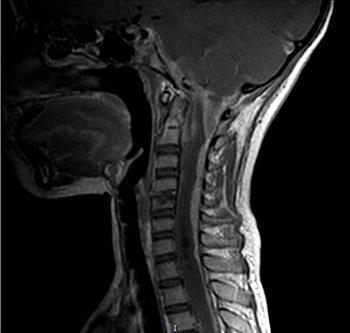 Rare Disease Illuminates Antifungal Immunity in the Brain