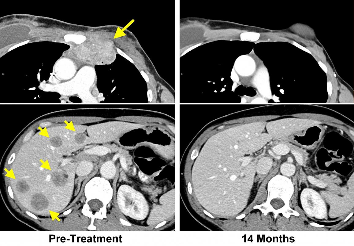 MRI scans of breast cancer before and after treatment with a new immunotherapy