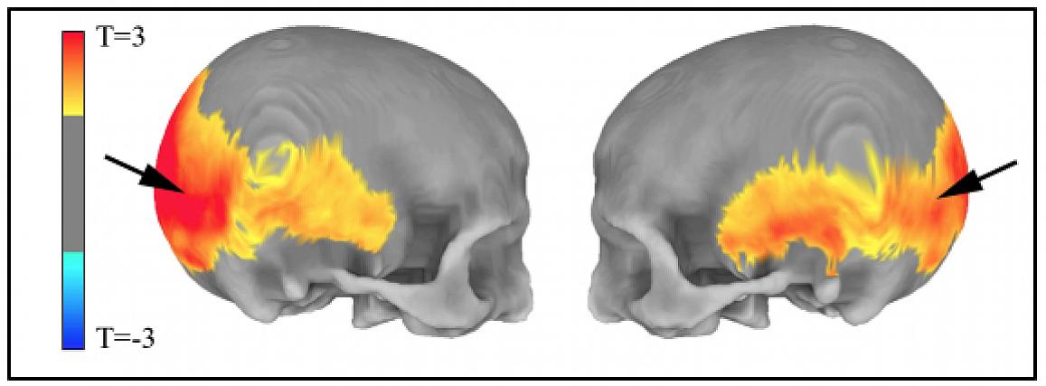 MRI data shows (left) areas of the skull preferentially affected by the amount of Neanderthal-derived DNA and (right) areas of the brain’s visual system in which Neanderthal gene variants influenced cortex folding (red) and gray matter volume (yellow).