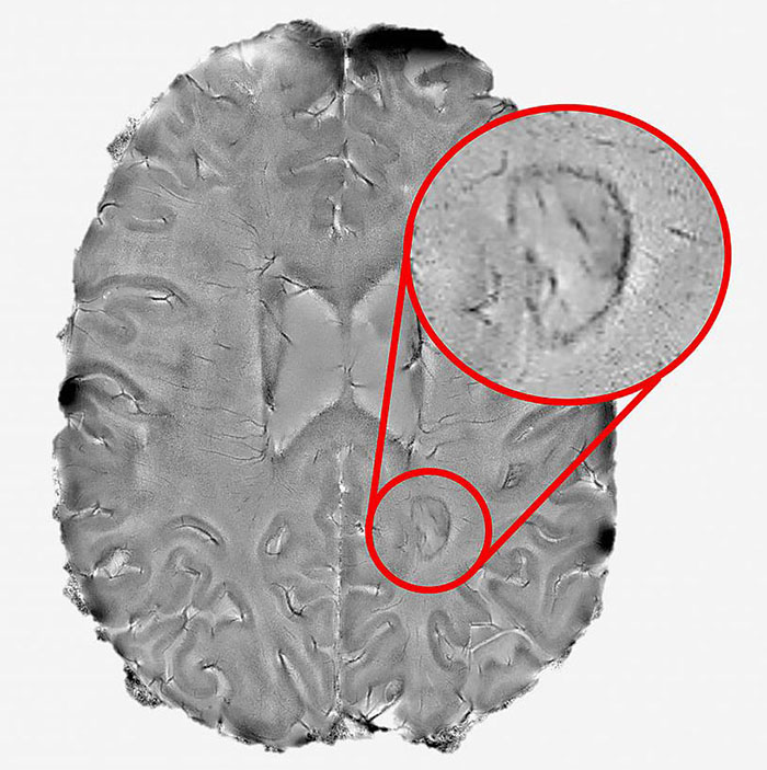 MRI image of a brain showing dark rimmed spots representing ongoing, “smoldering” inflammation