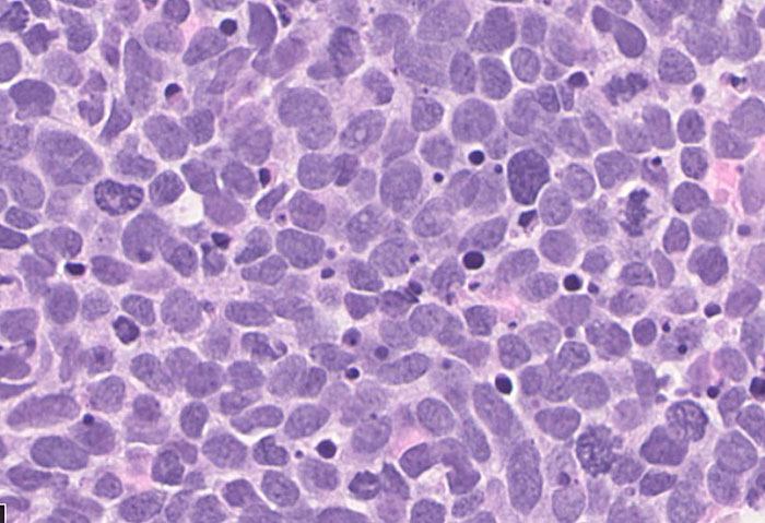 Small cell lung carcinoma cells