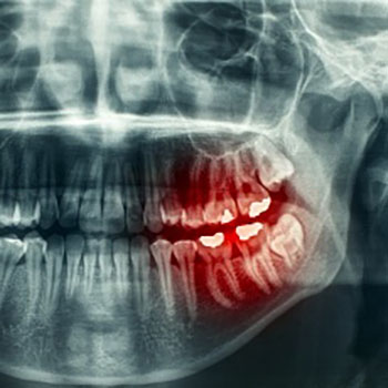 dental xray showing damage to teeth