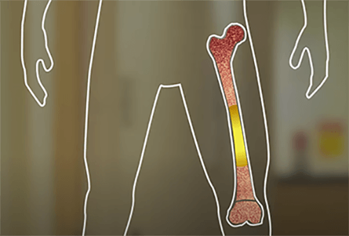 illustration of activated bone marrow in a bone
