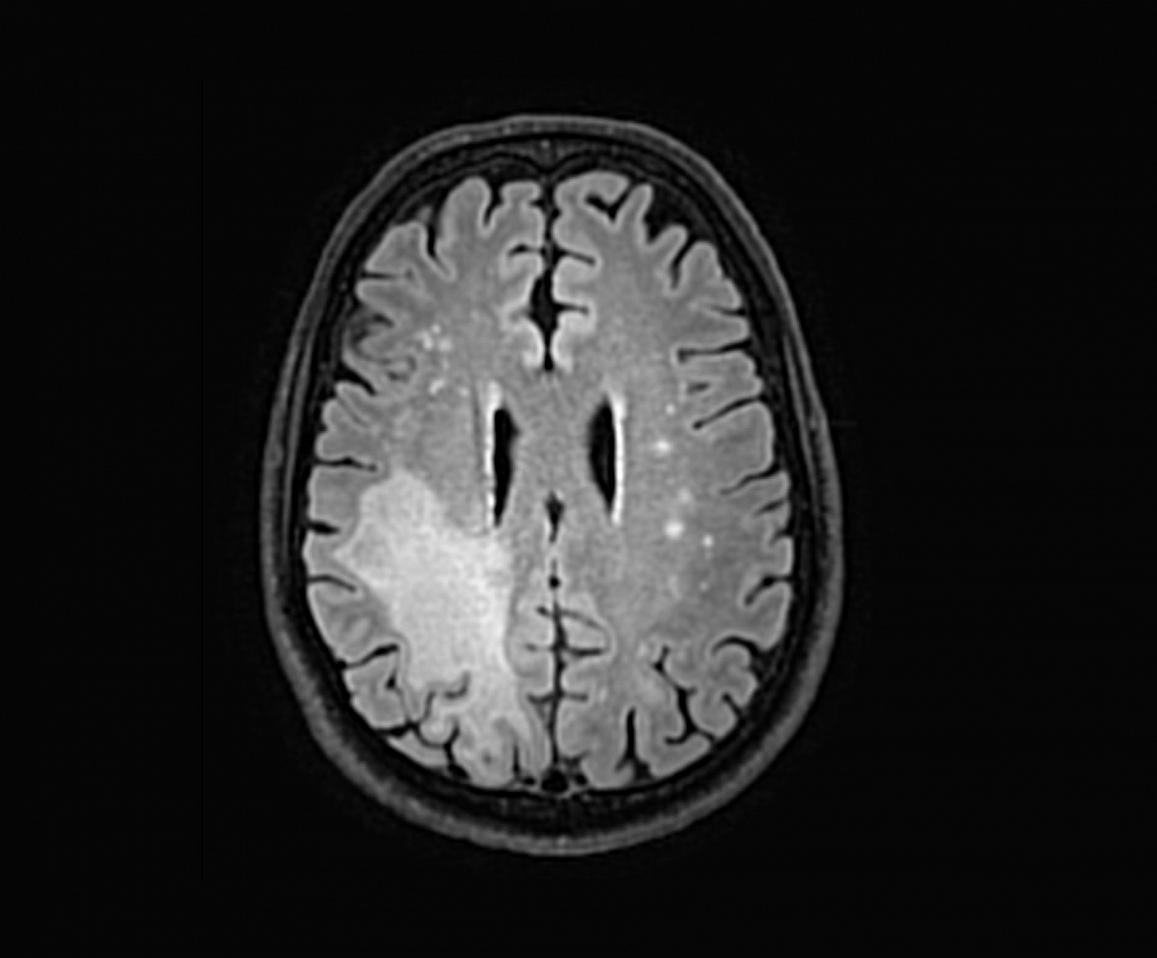 MRI of a PML patient showing significant lesions in the brain (white signal)