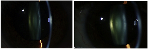 Space Lab Technology May Help Researchers Detect Early Signs of Cataract