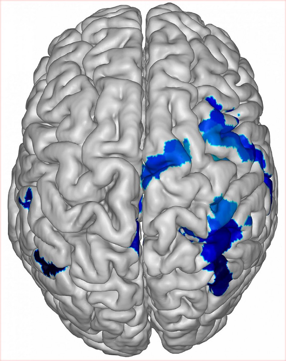 magnetoencephalography image showing activity in the brain