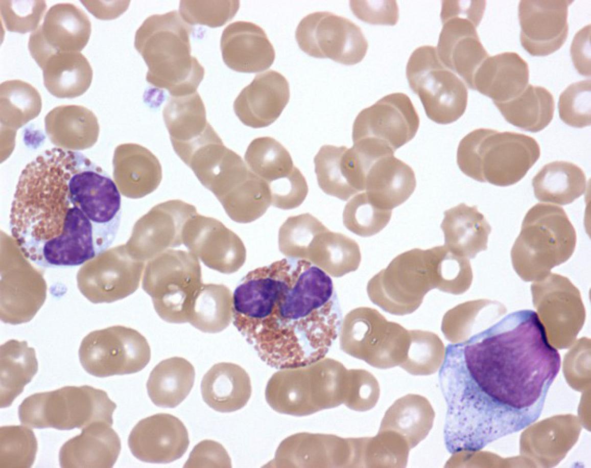 Activated eosinophils in the peripheral blood of a patient with idiopathic hypereosinophilic syndrome