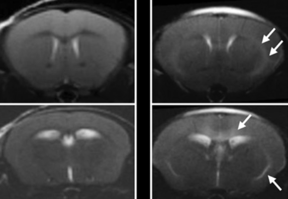 MRI brain scans of mice with (right) and without (left) cerebral malaria, indicating areas of damage to the blood-brain barrier