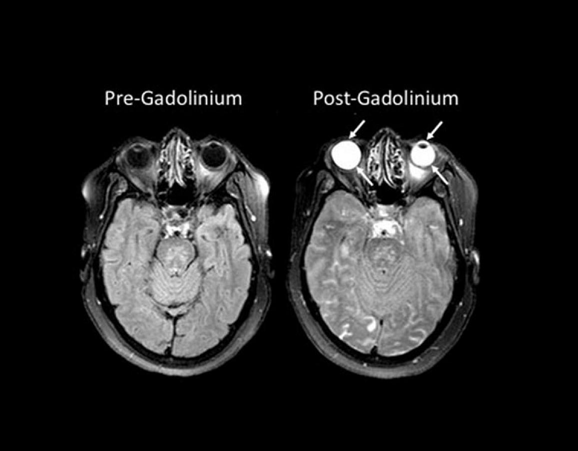 brain scan images before and after the use of a chemical called gadolinium
