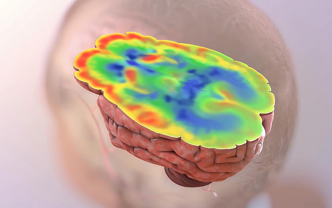 Illustration of elevated glucose levels in the brain