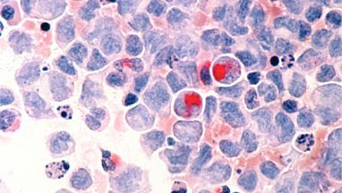 acute myeloid leukemia cells