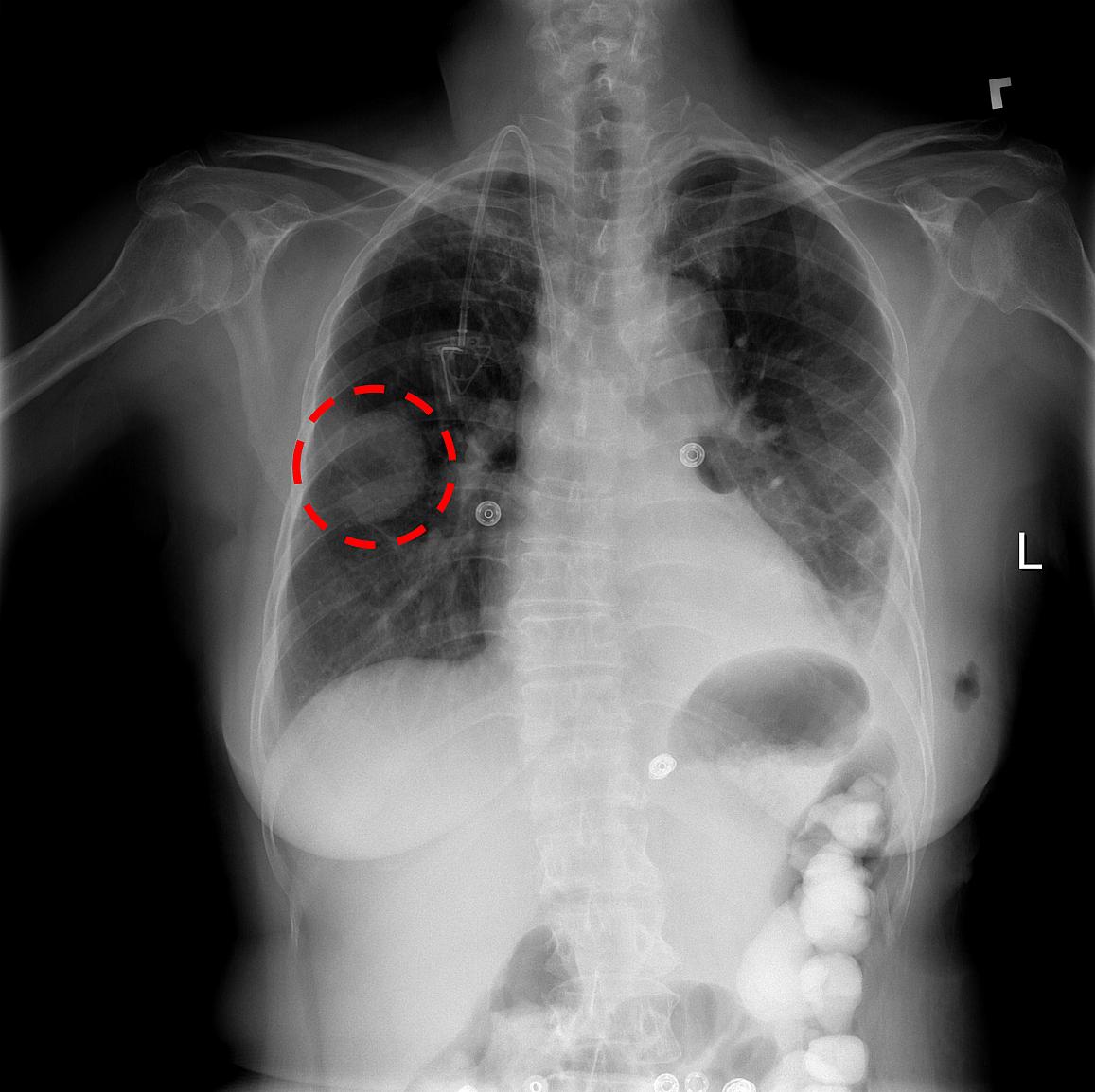 A chest x-ray identifies a lung mass.