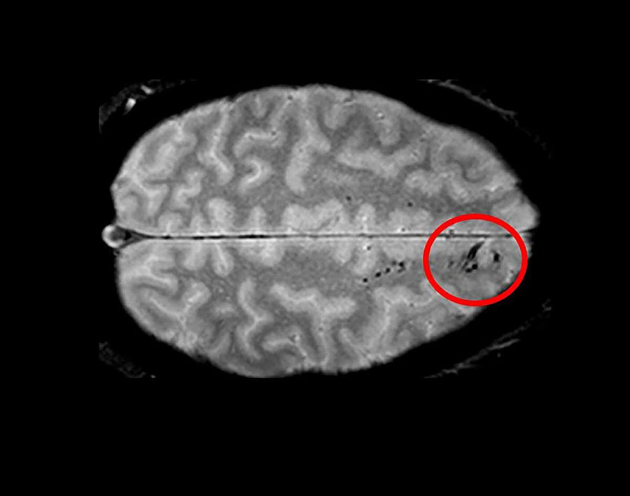 MRI scan showing microbleeds in the brain