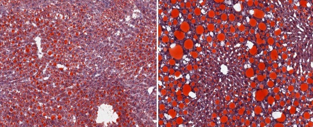 Image of normal mouse liver with steatosis (left) and liver of a mouse lacking IFN-gamma showing markedly higher steatosis