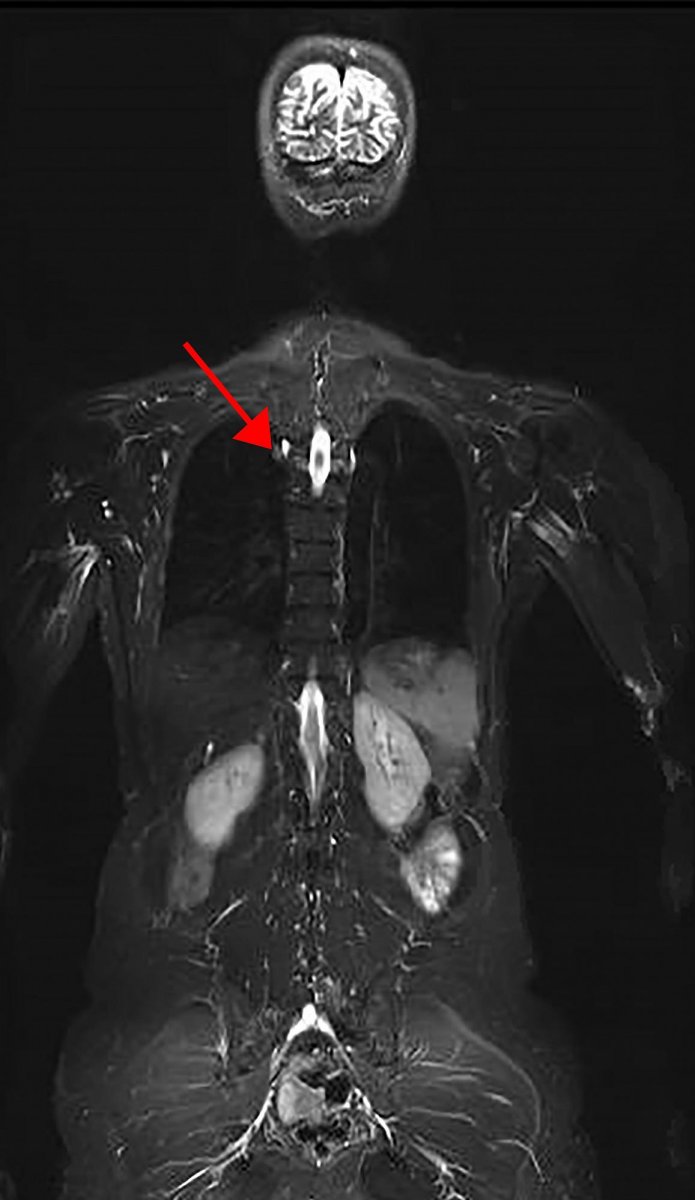 Part of a representative image of a whole body MRI of an LFS patient. Arrow denotes lesion found to be lung adenocarcinoma.
