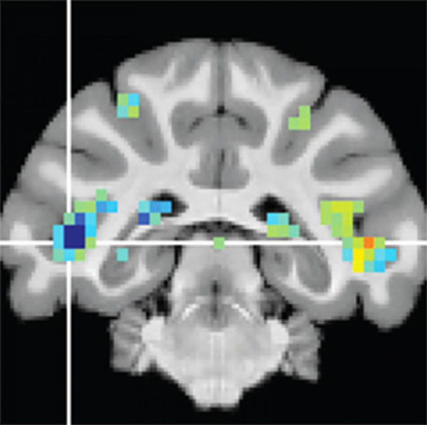 fMRI scan showing activity changes in the brain's superior temporal sulcus