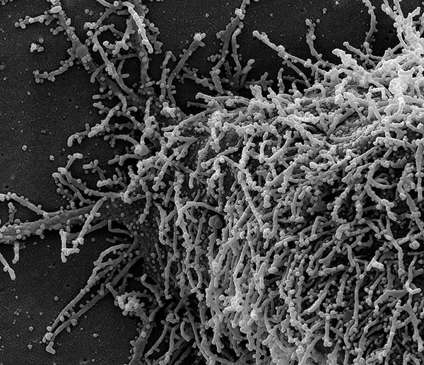 A single elongated CCL-81 cell heavily infected with SARS-CoV-2 virus particles.