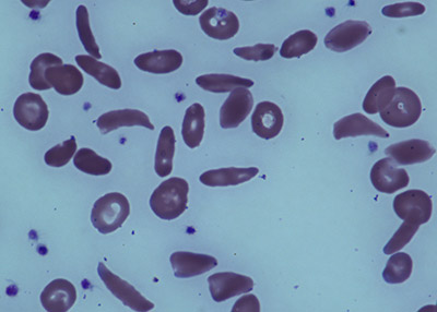 Adults stop anti-rejection drugs after partial stem-cell transplant reverses sickle cell disease