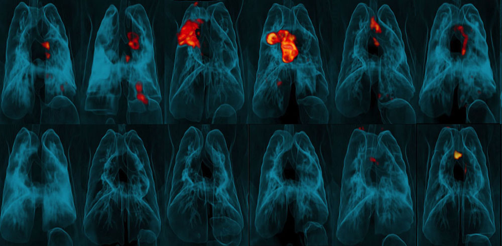 Three-dimensional PET-CT scans of lungs showing areas of TB infection and tissue inflammation (red and orange)