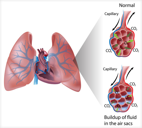 diagram of fluid buildup in the lungs' air sacs