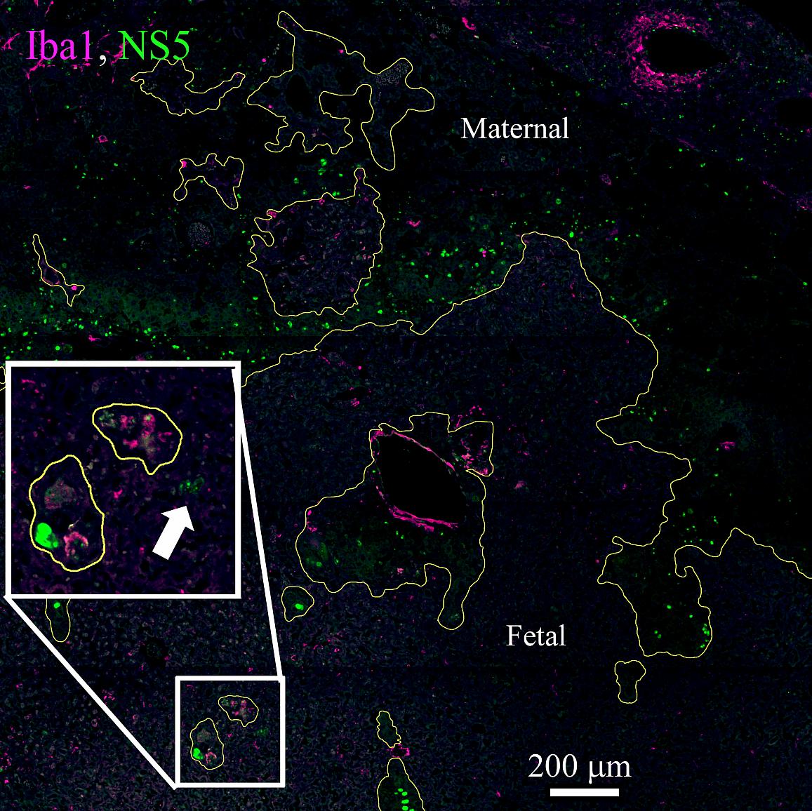 Placenta from Zika-infected mouse showing heavy virus infection (green fluorescence) on the maternal side and limited infection on the fetal side. The yellow line designates maternal vs fetal tissue, and the insert shows infection of virus (arrow) on the fetal side of the placenta.