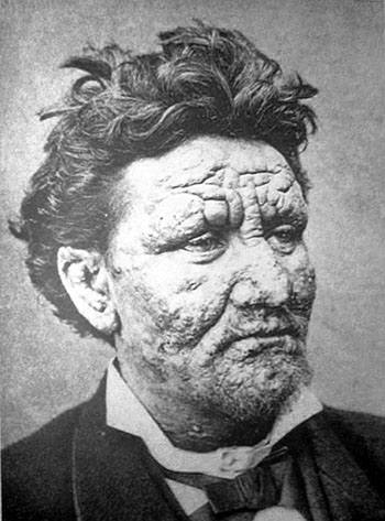 Man with leprosy--disfigured face