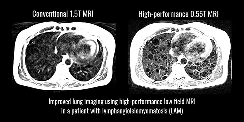 Black and white M-R-I image of cross-section of lungs