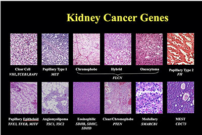 magnified images of tissue from 12 different types of kidney cancer; genes identified for each