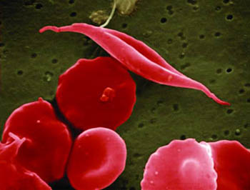 normal red blood cells and a sickle-shaped blood cell