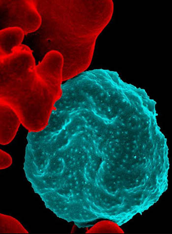 Colorized scanning electron micrograph of red blood cell infected with malaria parasites compared to uninfected cells with a smooth red surface