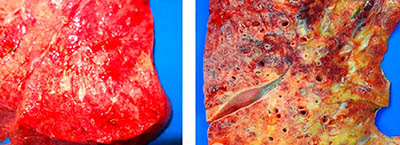 Diffuse alveolar damage (DAD) in the lungs