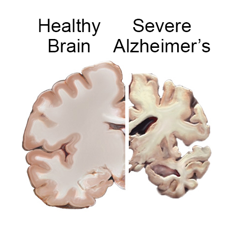 brain slices - healthy brain compared to severe alzheimers