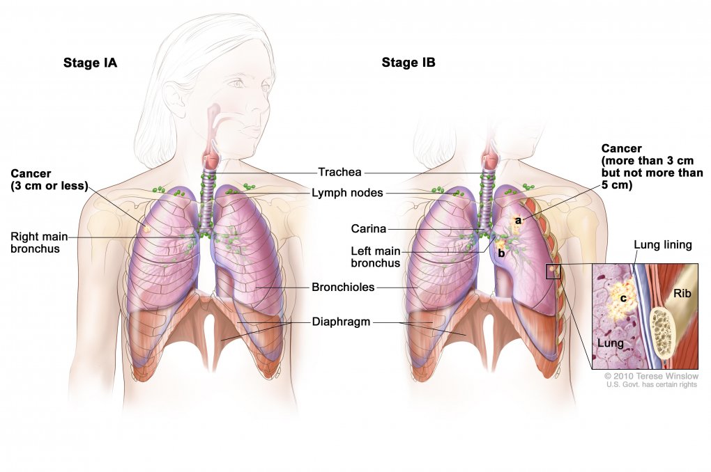 A panel of genetic markers may identify patients with stage I lung cancer with a poor prognosis, suggesting that they may benefit from post-surgical chemotherapy.