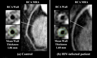 magnetic resonance images of cross-sections of coronary vessels