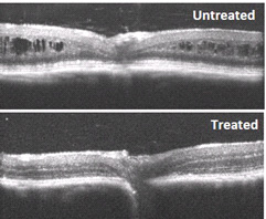 retina--two cross-sectional images