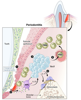 illustration of path of periodontitis