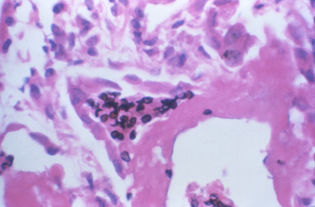 magnified image of pneumocystis pathogen in lung tissue