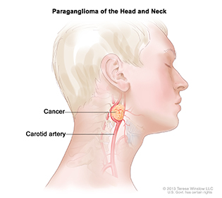 Illustration of side view of person's neck showing tumor under ear and blood vessels