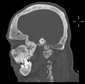x-ray of skull, side view; showing some unevenness