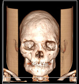 front view of skull showing unevenness in the bone structure