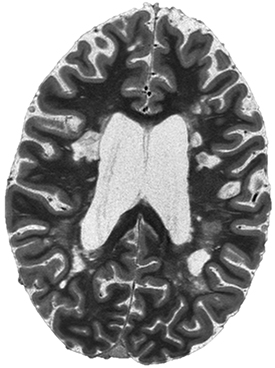  MRI image of brain showing lesions