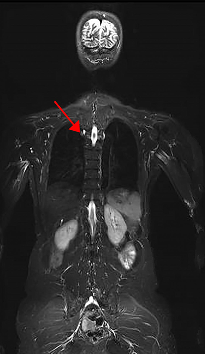 MRI image of whole body